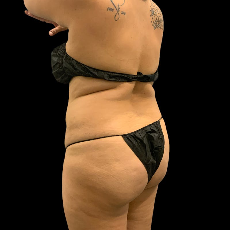 Brazilian Butt Lift Before & After Gallery - Patient 211801 - Image 5