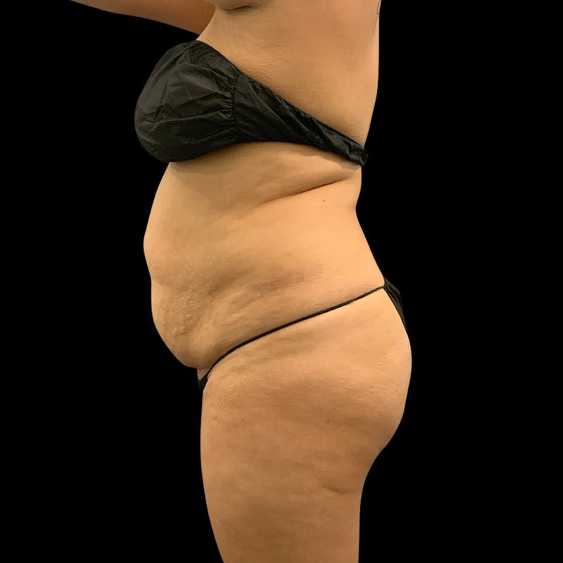 Brazilian Butt Lift Before & After Gallery - Patient 211801 - Image 7