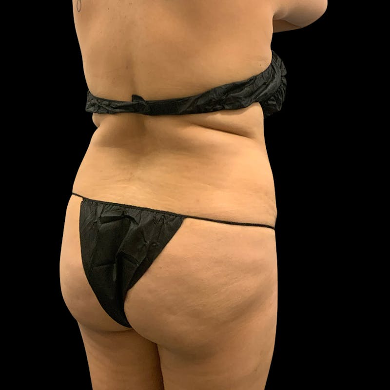 Brazilian Butt Lift Before & After Gallery - Patient 211801 - Image 1