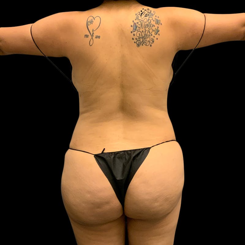 Brazilian Butt Lift Before & After Gallery - Patient 211801 - Image 4