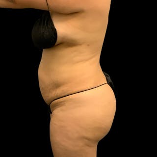 Brazilian Butt Lift Before & After Gallery - Patient 211801 - Image 8
