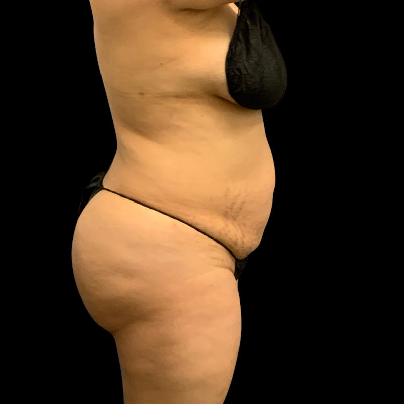 Brazilian Butt Lift Before & After Gallery - Patient 211801 - Image 10