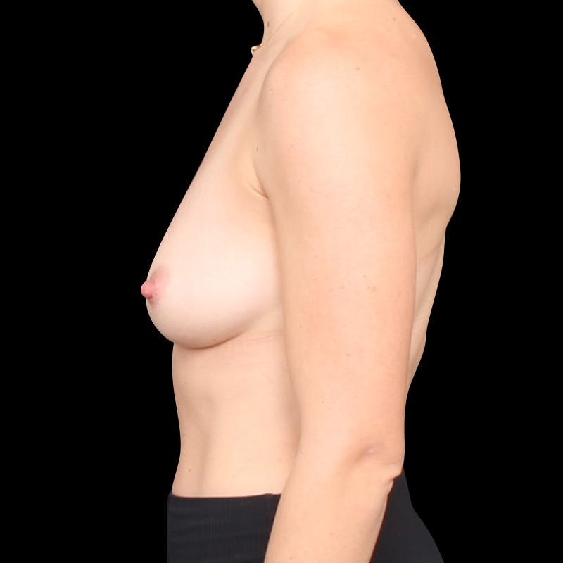 Breast Augmentation Before & After Gallery - Patient 864959 - Image 9