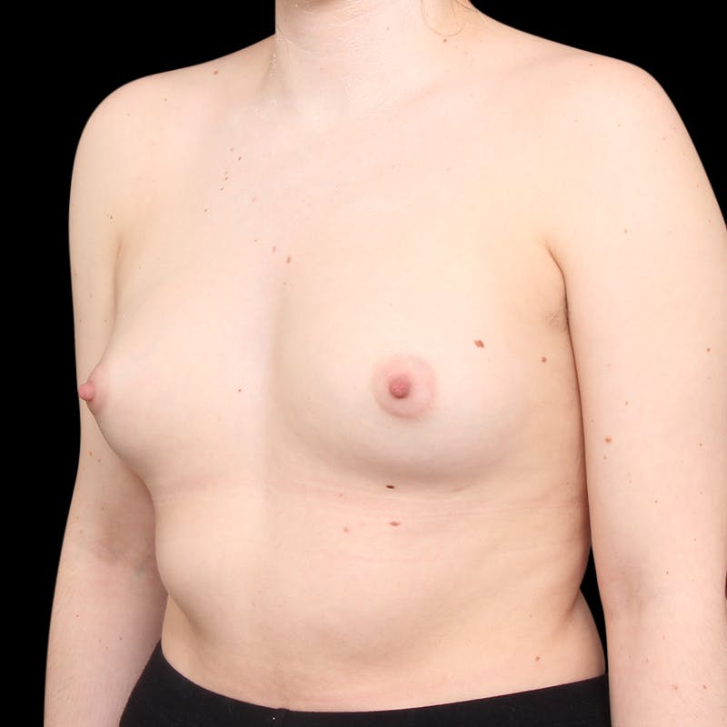 Breast Augmentation Before & After Gallery - Patient 362805 - Image 7