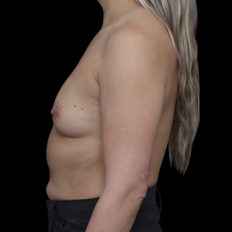 Breast Augmentation Before & After Gallery - Patient 354950 - Image 9
