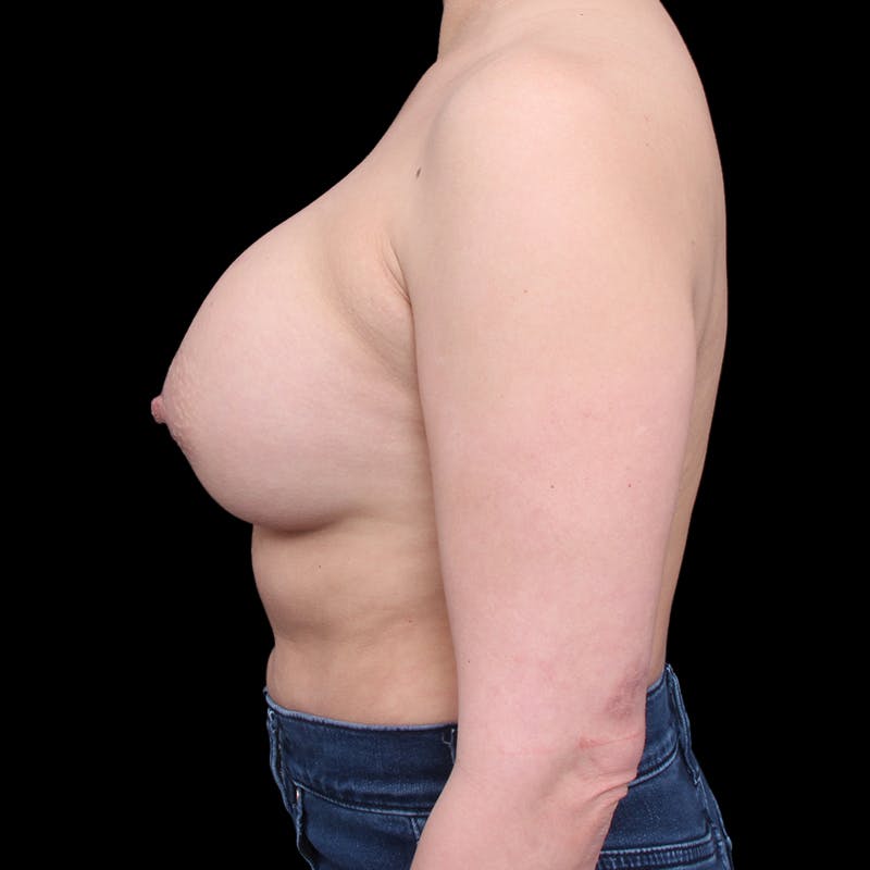 Breast Augmentation Before & After Gallery - Patient 354950 - Image 10