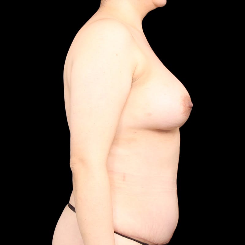 Breast Augmentation Before & After Gallery - Patient 151480 - Image 6
