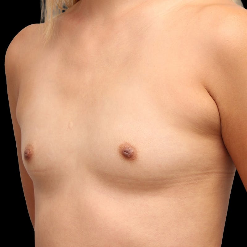 Breast Augmentation Before & After Gallery - Patient 325946 - Image 9