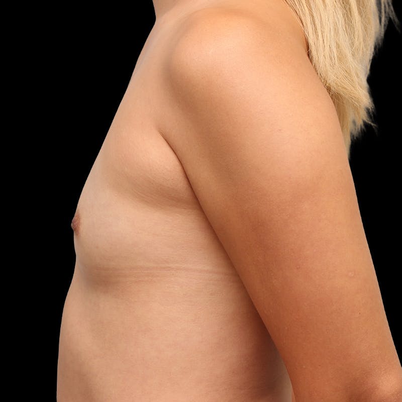 Breast Augmentation Before & After Gallery - Patient 325946 - Image 7