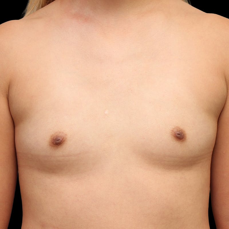 Breast Augmentation Before & After Gallery - Patient 325946 - Image 1