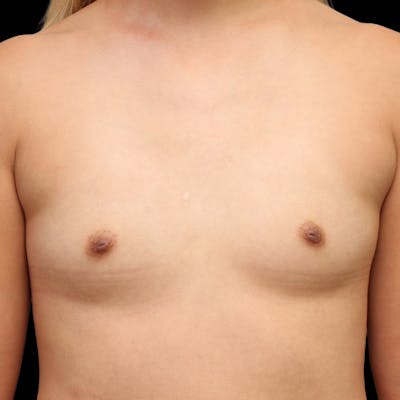 Breast Augmentation Before & After Gallery - Patient 325946 - Image 1