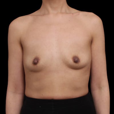 Breast Augmentation Before & After Gallery - Patient 482889 - Image 1