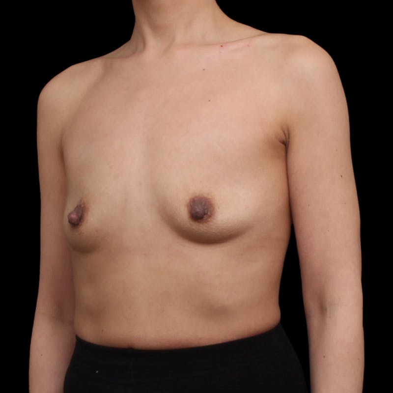 Breast Augmentation Before & After Gallery - Patient 482889 - Image 7