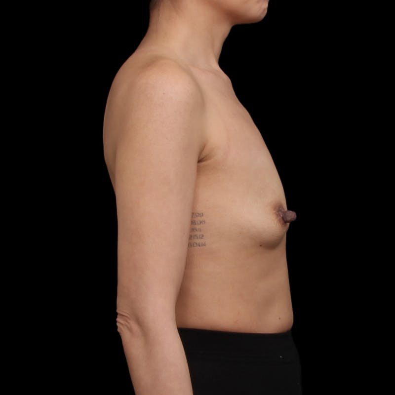 Breast Augmentation Before & After Gallery - Patient 482889 - Image 5