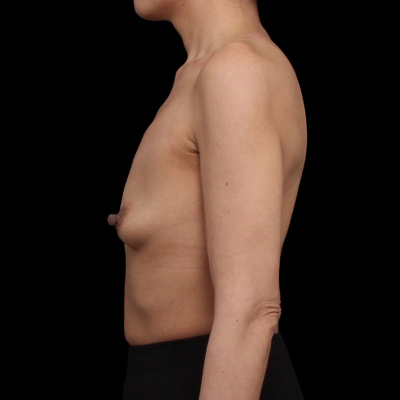 Breast Augmentation Before & After Gallery - Patient 482889 - Image 9