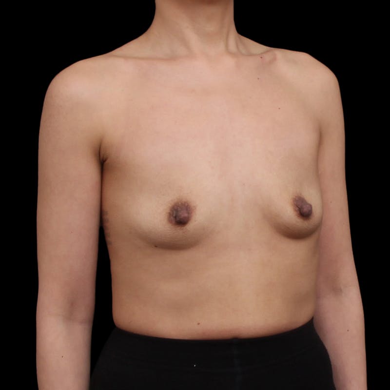 Breast Augmentation Before & After Gallery - Patient 482889 - Image 3