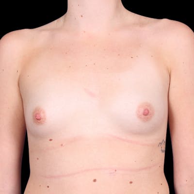 Breast Augmentation Before & After Gallery - Patient 344989 - Image 1