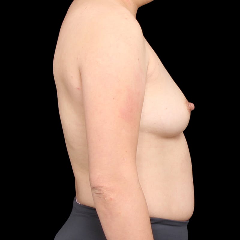 Breast Augmentation Before & After Gallery - Patient 184072 - Image 5
