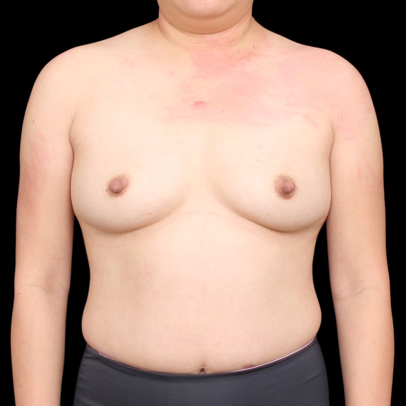 Breast Augmentation Before & After Gallery - Patient 184072 - Image 1