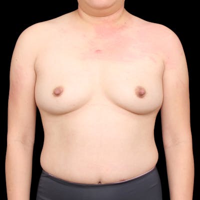 Breast Augmentation Before & After Gallery - Patient 184072 - Image 1