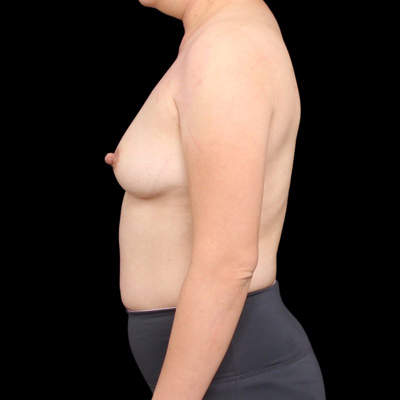 Breast Augmentation Before & After Gallery - Patient 184072 - Image 9