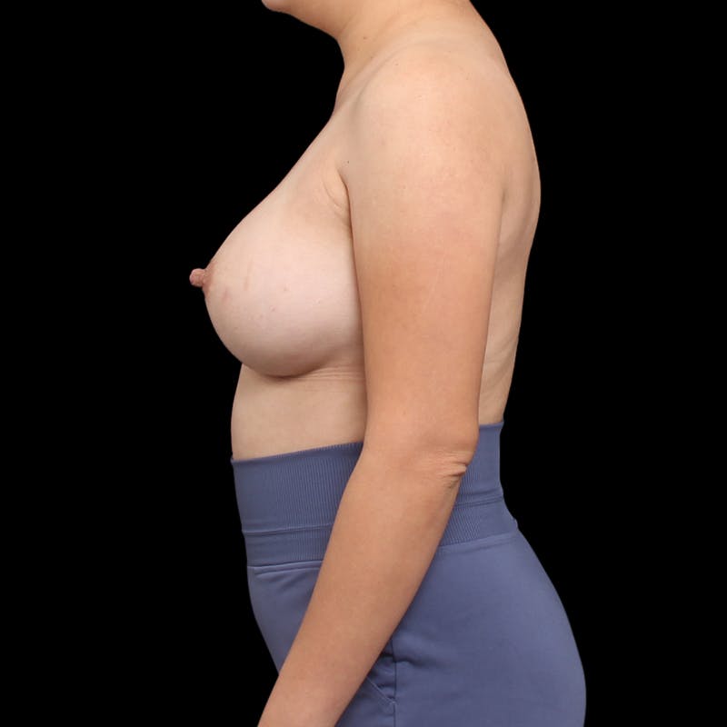 Breast Augmentation Before & After Gallery - Patient 184072 - Image 10