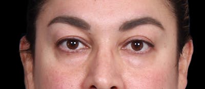 Lower Blepharoplasty Before & After Gallery - Patient 223916 - Image 1