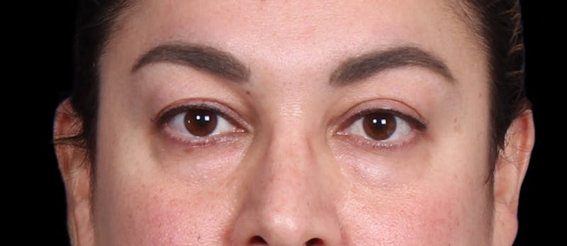 Lower Blepharoplasty Before & After Gallery - Patient 223916 - Image 1
