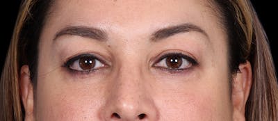 Lower Blepharoplasty Before & After Gallery - Patient 223916 - Image 2