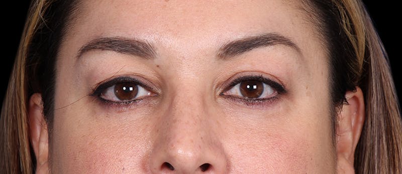 Lower Blepharoplasty Before & After Gallery - Patient 223916 - Image 2