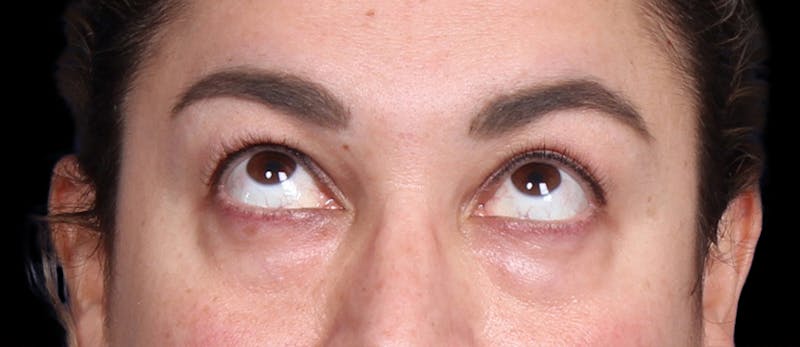 Lower Blepharoplasty Before & After Gallery - Patient 223916 - Image 3