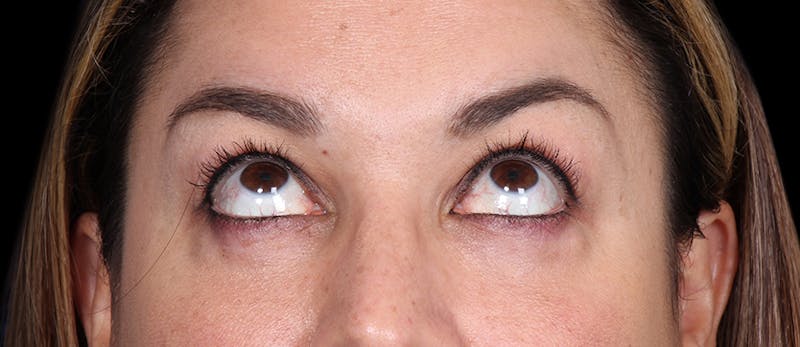 Lower Blepharoplasty Before & After Gallery - Patient 223916 - Image 4