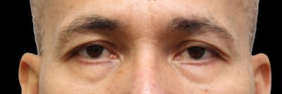 Lower Blepharoplasty Before & After Gallery - Patient 151964 - Image 1