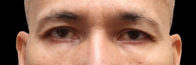 Lower Blepharoplasty Before & After Gallery - Patient 151964 - Image 2