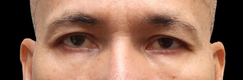 Lower Blepharoplasty Before & After Gallery - Patient 151964 - Image 2