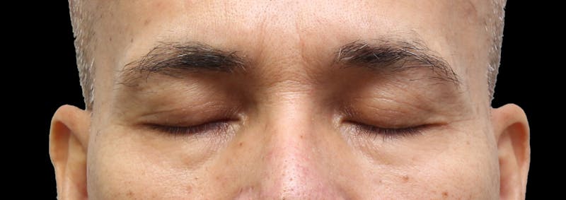 Lower Blepharoplasty Before & After Gallery - Patient 151964 - Image 3
