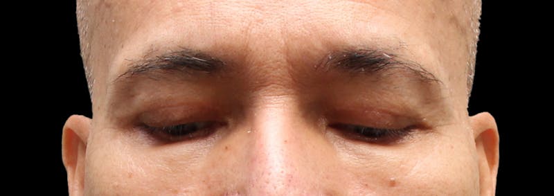 Lower Blepharoplasty Before & After Gallery - Patient 151964 - Image 4