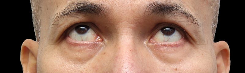 Lower Blepharoplasty Before & After Gallery - Patient 151964 - Image 5