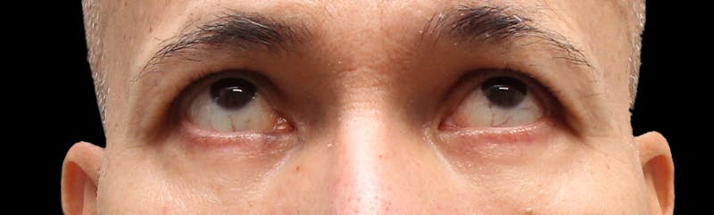 Lower Blepharoplasty Before & After Gallery - Patient 151964 - Image 6
