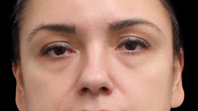Lower Blepharoplasty Before & After Gallery - Patient 677238 - Image 1