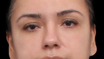 Lower Blepharoplasty Before & After Gallery - Patient 677238 - Image 2