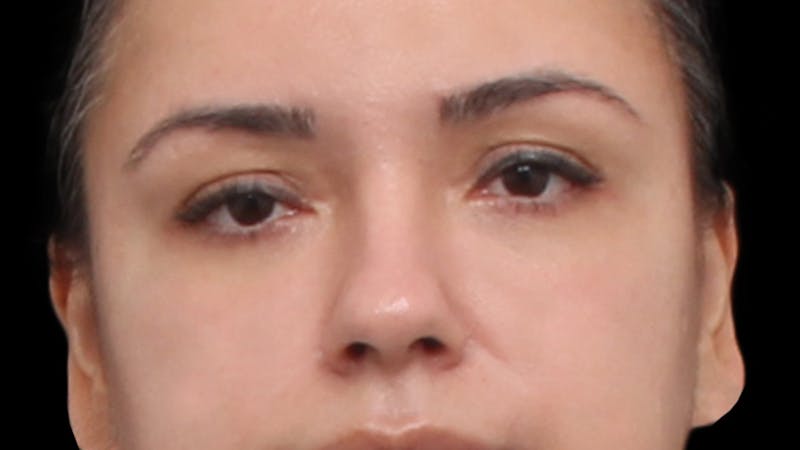 Lower Blepharoplasty Before & After Gallery - Patient 677238 - Image 2