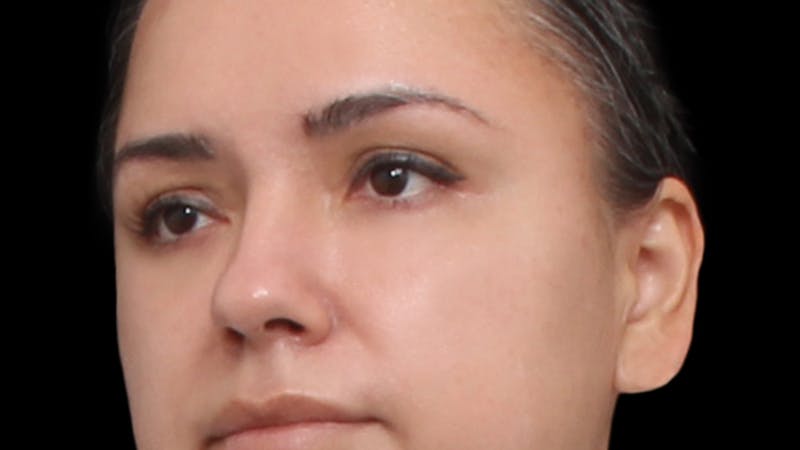Lower Blepharoplasty Before & After Gallery - Patient 677238 - Image 8