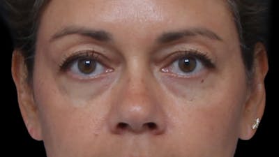 Lower Blepharoplasty Before & After Gallery - Patient 131647 - Image 1