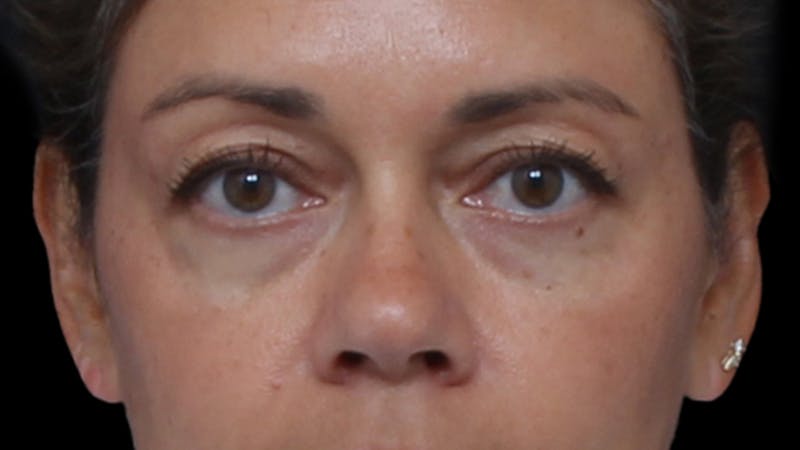 Upper Blepharoplasty Before & After Gallery - Patient 345569 - Image 1