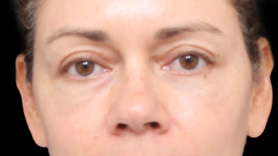 Lower Blepharoplasty Before & After Gallery - Patient 131647 - Image 2
