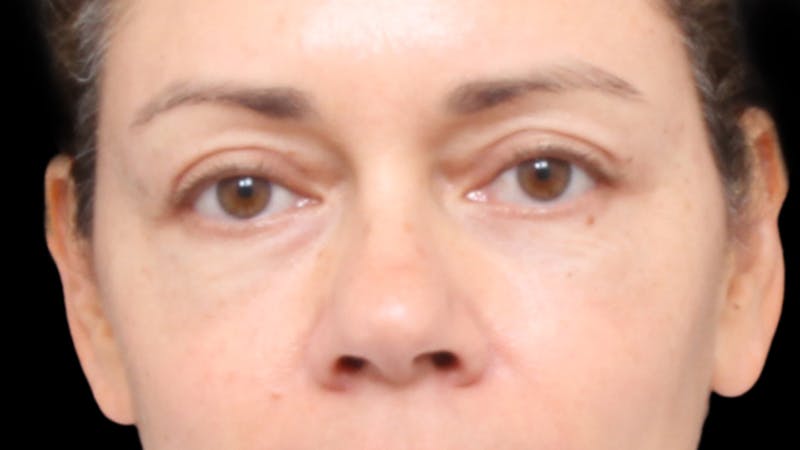 Upper Blepharoplasty Before & After Gallery - Patient 345569 - Image 2