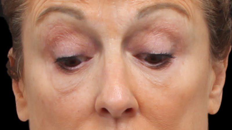 Upper Blepharoplasty Before & After Gallery - Patient 129200 - Image 3