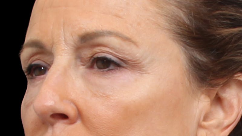 Upper Blepharoplasty Before & After Gallery - Patient 129200 - Image 5