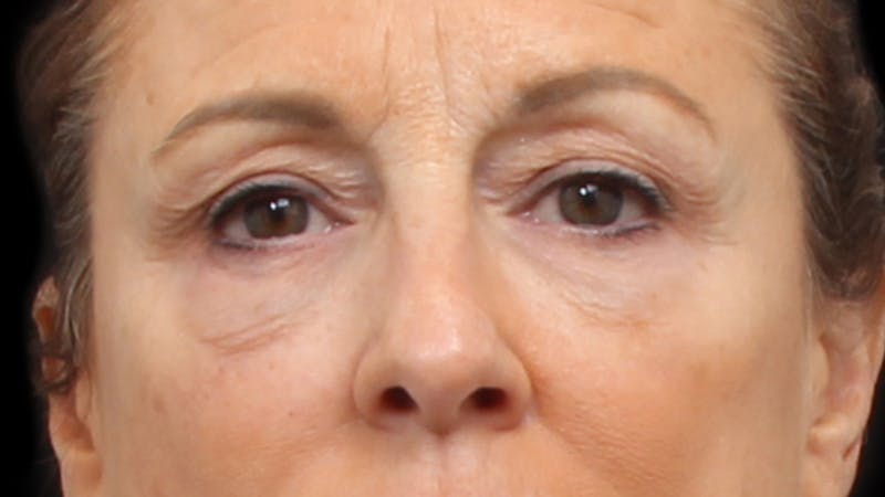 Upper Blepharoplasty Before & After Gallery - Patient 129200 - Image 1